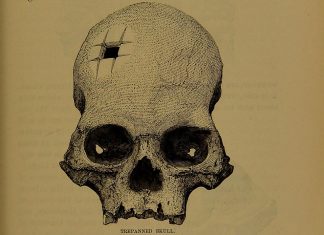 O crânio com perfuração quadrada que confirmou que os incas realizavam cirurgias complexas